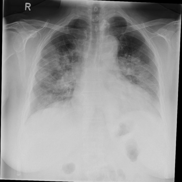 COVID-19 Pneumonie