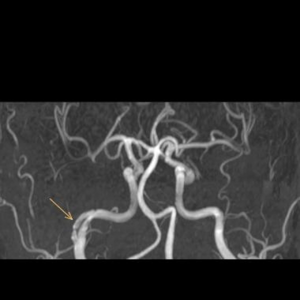 #Dissektion #Schwindel #MRT #MRT des Kopfes #Taubheitsgefühl #TOF #Arteria carotis
