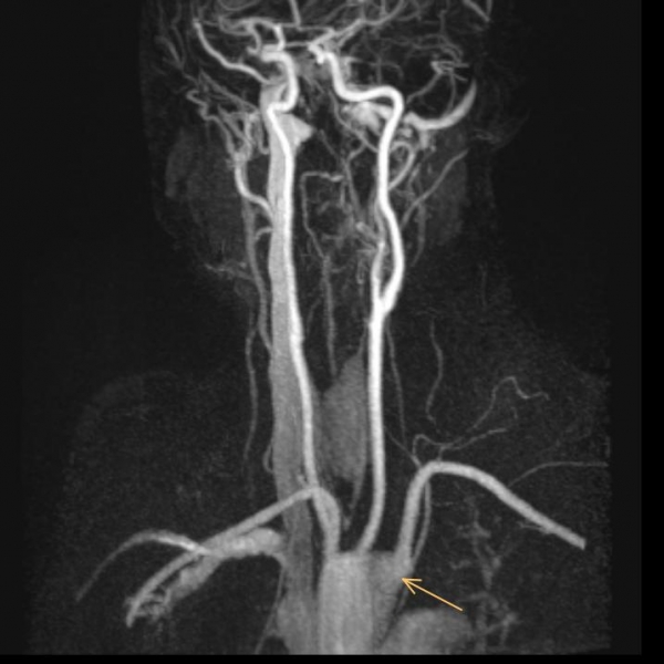 #A. lusoria #Dysphagia lusoria #Schluckbeschwerden #Arteria lusoria #anatomische Variante #Arteria subclavia dexter