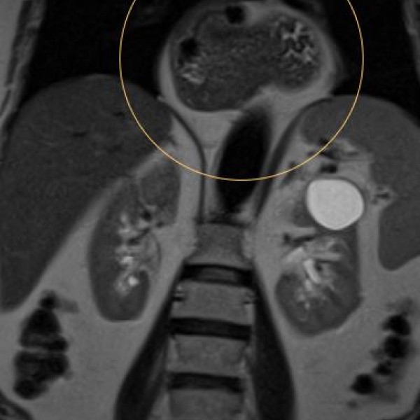 #Hiatushernie #paraösophageale Hernie #Upside-down-stomach #Rotation der Magenachse #Inkarzeration